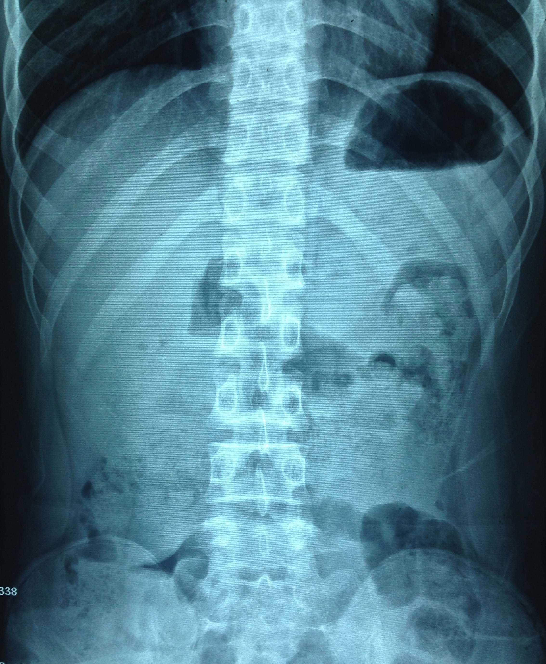 肠梗阻的x线表现,肠梗阻的基本线表现,肠梗阻的线表现图片_大山谷图库
