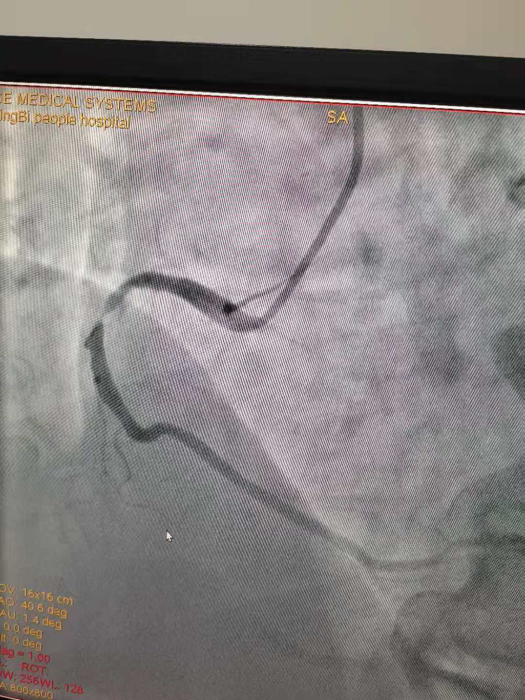 激光切割SUS304 316血管支架 心脏瓣膜支架 镍钛合金膨胀支架切割-阿里巴巴